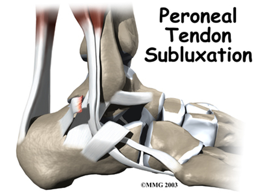 Peroneal Tendon Subluxation Therapy – Hesch Institute