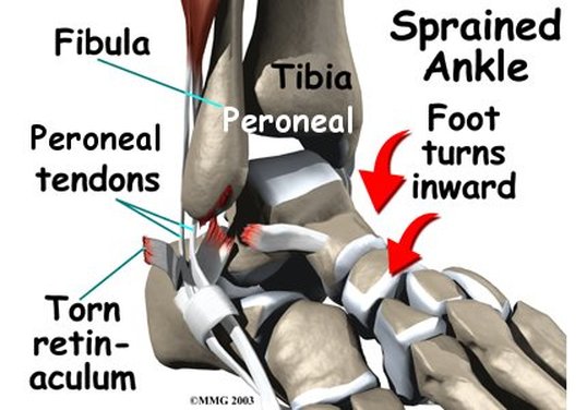 Fibula, Peroneal Tendons, Torn Retinaculum, Foot Turn Inward, Tibia & Sprained Ankle Therapy